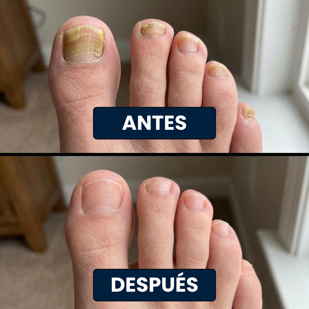 2x1 en Parches Antihongos Nocturno para las Uñas