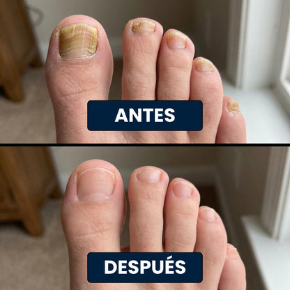 2x1 en Parches Antihongos Nocturno para las Uñas